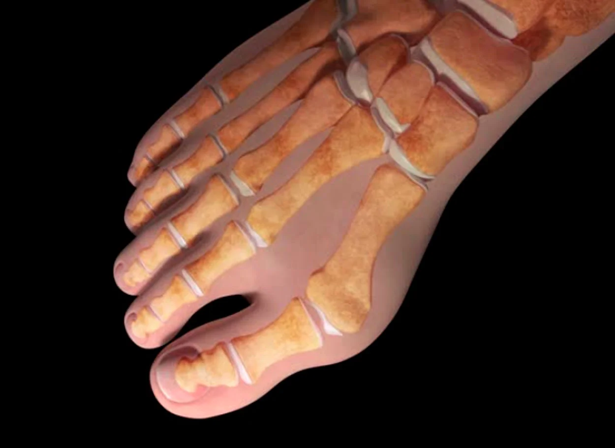 Hallux valgus — MIBRAR®方法治疗