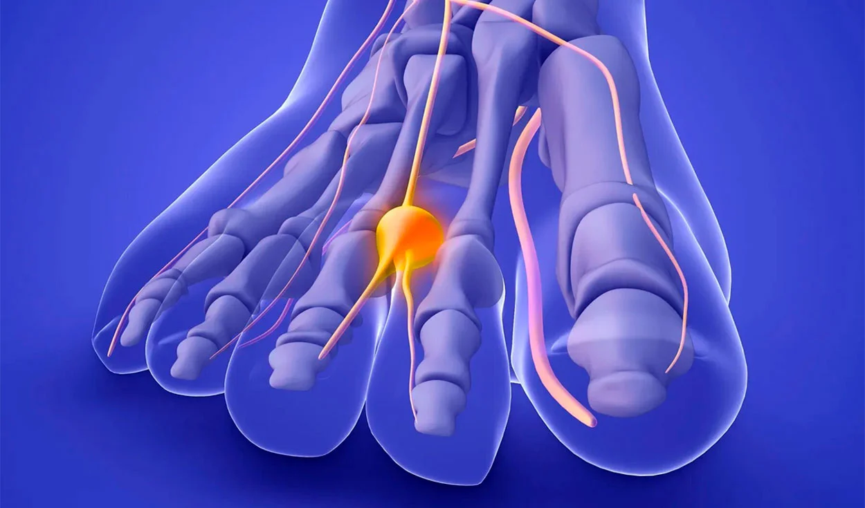 Neuroma di Morton — trattamento con il metodo MIBRAR®