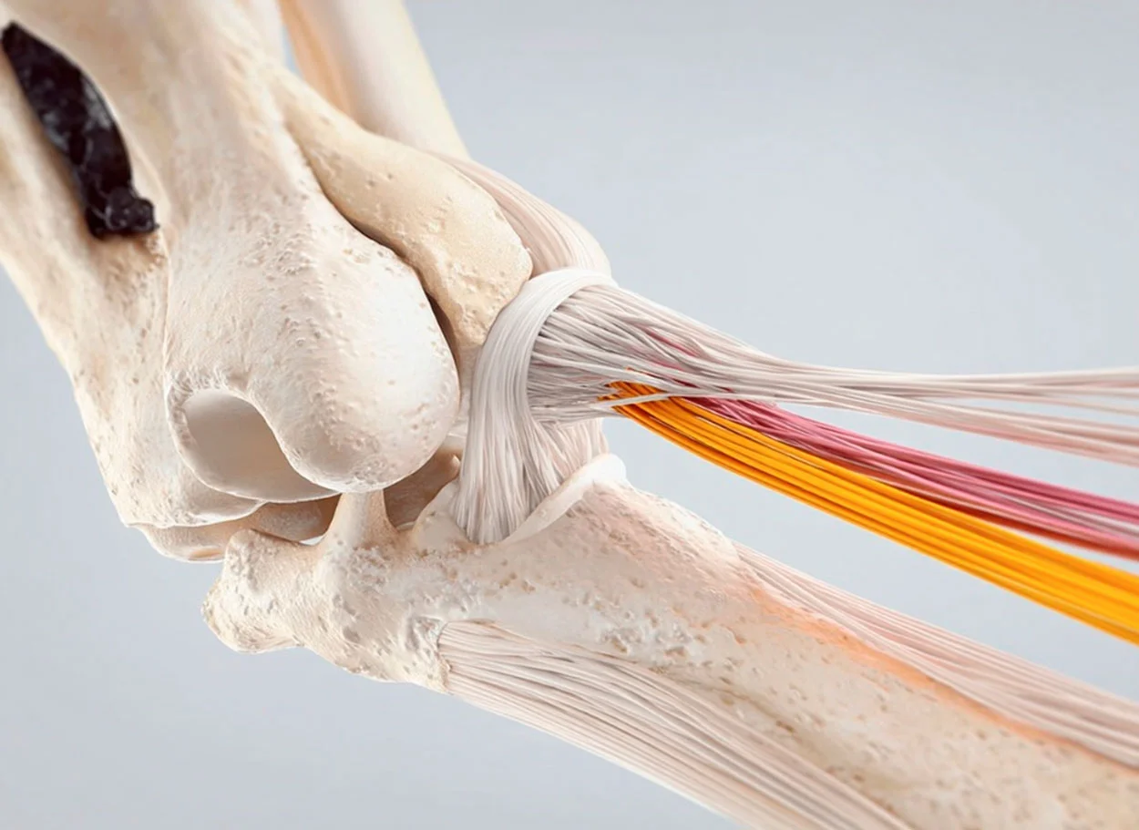 Epicondylitis — treatment with MIBRAR® method