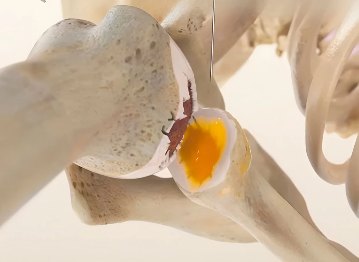 Arthrose des Schultergelenks — Behandlung mit der MIBRAR®-Methode