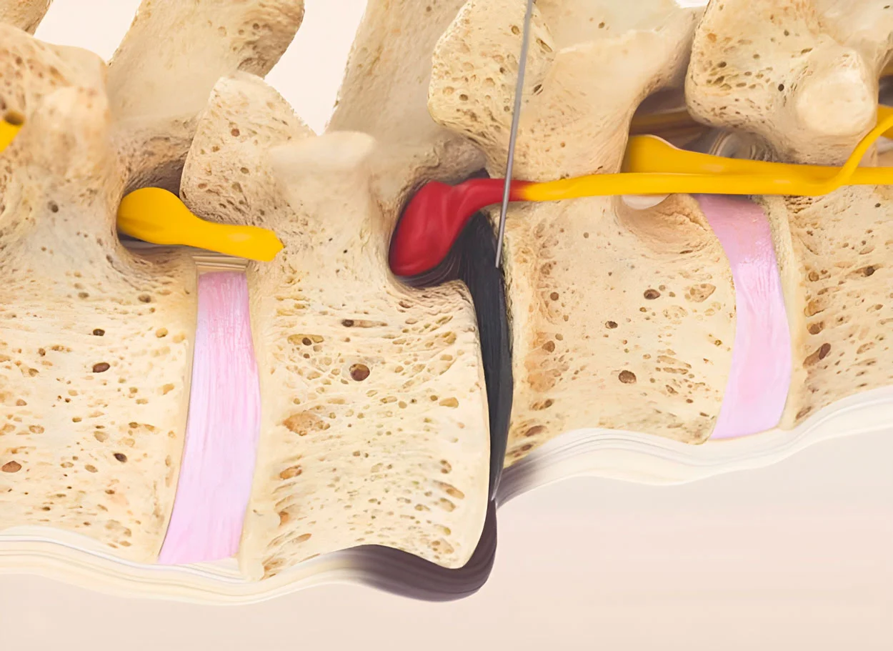 Spondylolisthese — Behandlung mit der MIBRAR®-Methode