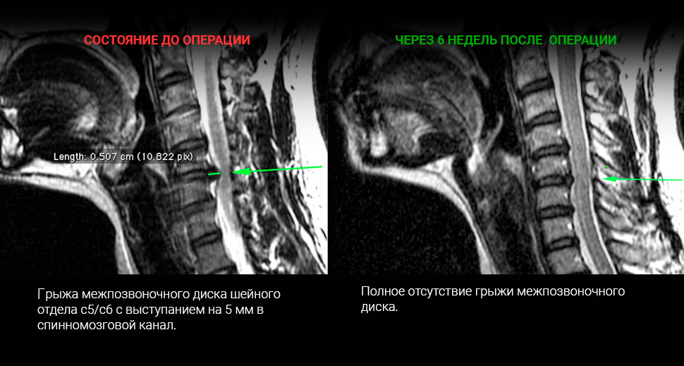 МРТ до и после лечения: Грыжа диска C5-C6