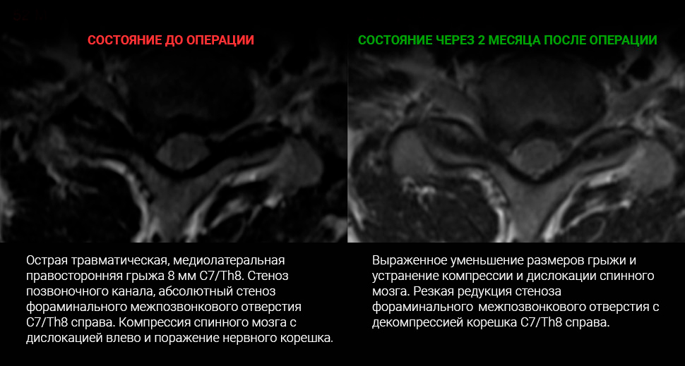 МРТ до и после лечения: Протрузия C4-C5, C5-C6