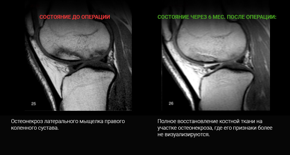 МРТ до и после лечения: Разрыв медиального мениска