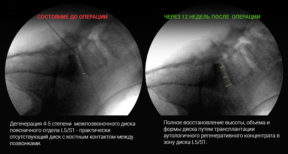 МРТ до и после лечения: Грыжа диска L4-L5