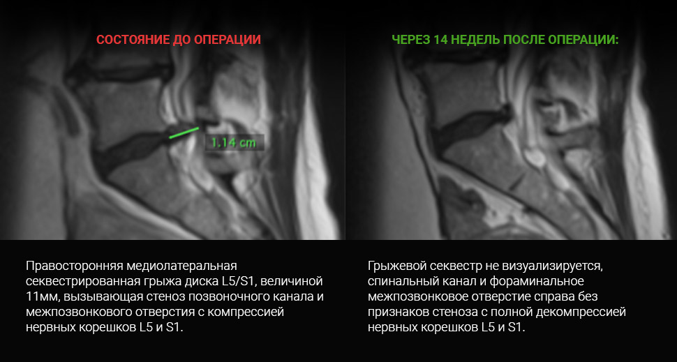 МРТ до и после лечения: Грыжа L5-S1 + стеноз