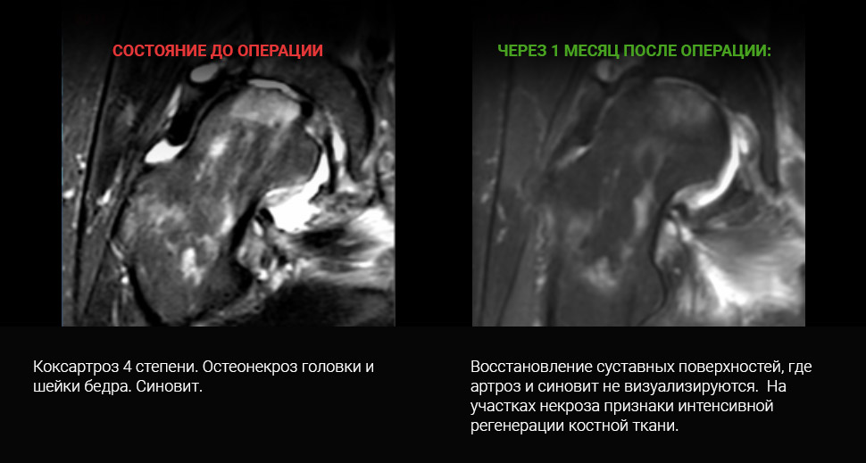 МРТ до и после лечения: Коксартроз II-III стадии